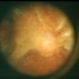 Fibrovascular Proliferation